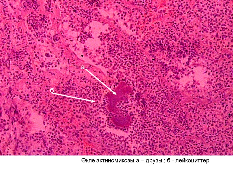 Өкпе актиномикозы а – друзы ; б - лейкоциттер